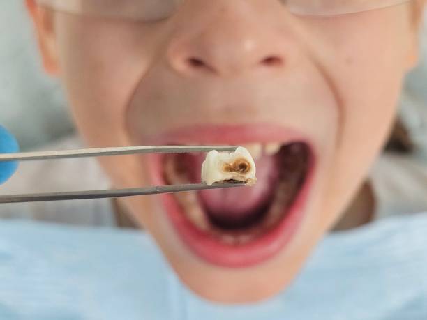 Best Emergency Dental Extractions in Ahwahnee, CA
